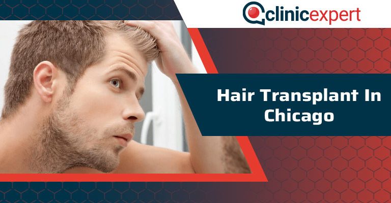 Hair Transplant In Chicago