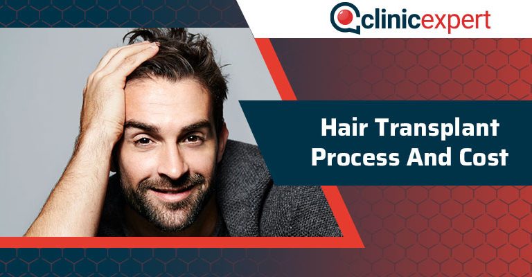 Hair Transplant Process And Cost