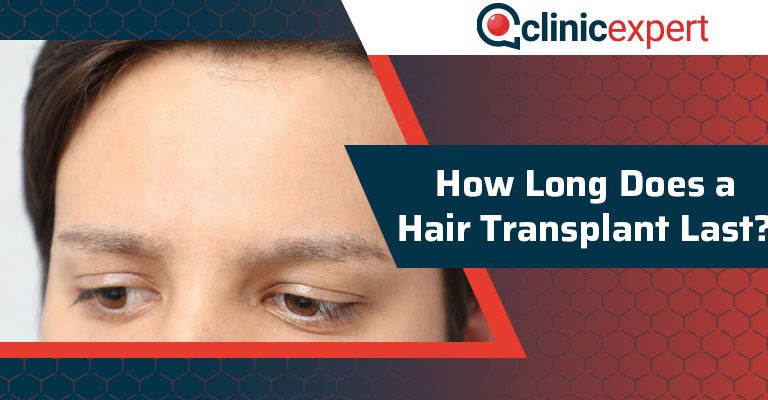 How Long Does a Hair Transplant Last?