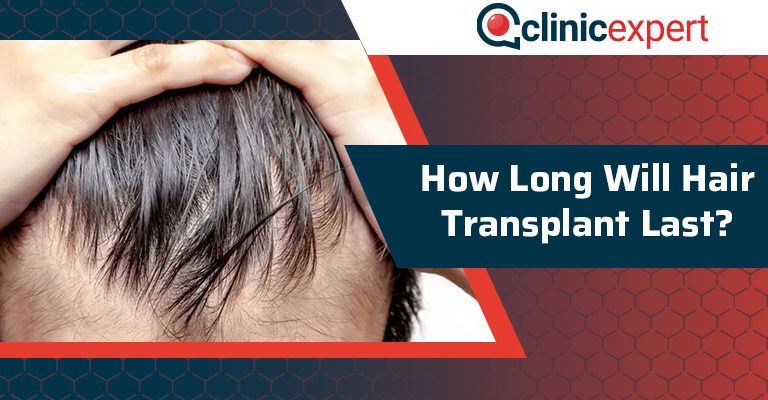 How Long Will Hair Transplant Last?