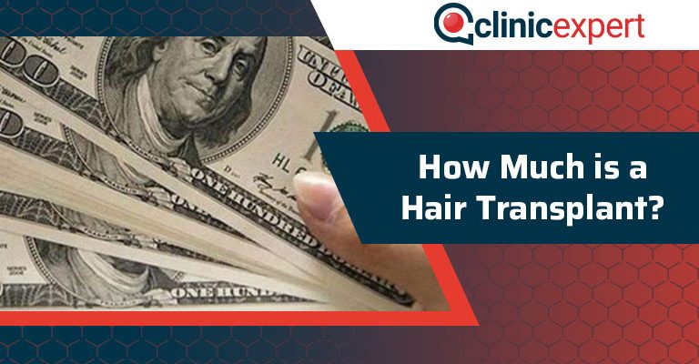 How Much Is A Hair Transplant?