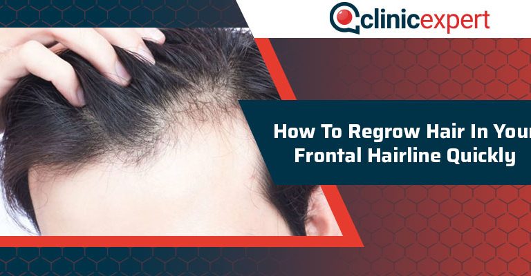 How To Regrow Hair In Your Frontal Hairline Quickly?