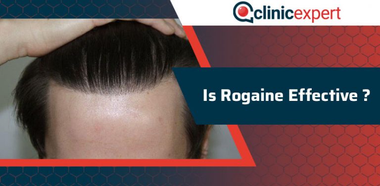 is-rogaine-effective-clinicexpert