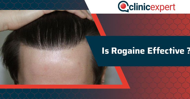  Is Rogaine Effective?