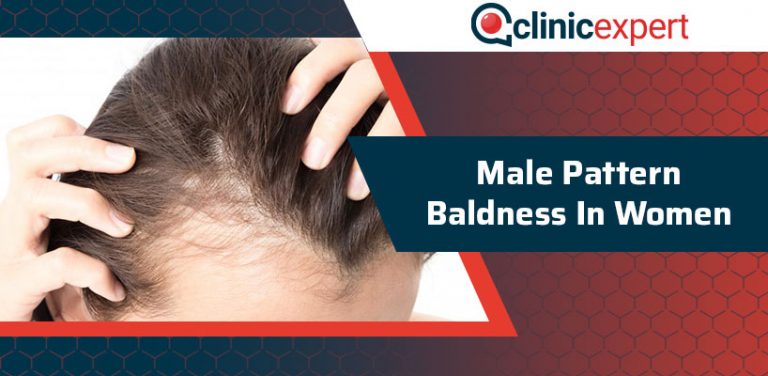 Male Pattern Baldness In Women ClinicExpert