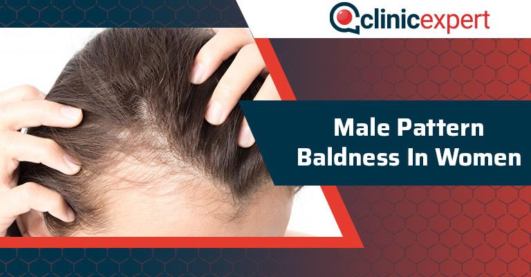 Male Pattern Baldness In Women