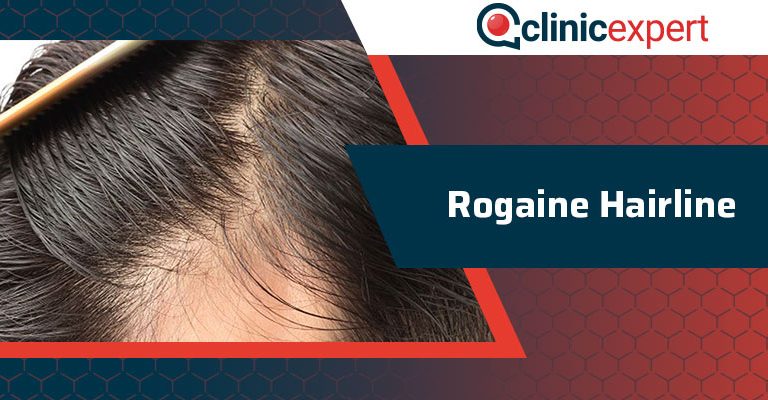 Rogaine Hairline