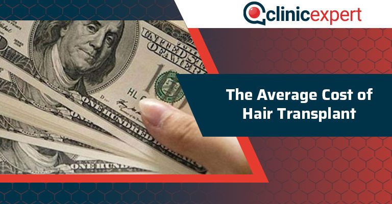 The Average Cost of Hair Transplant