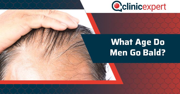 What Age Do Men Go Bald?