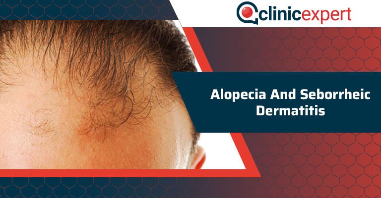 Alopecia And Seborrheic Dermatitis