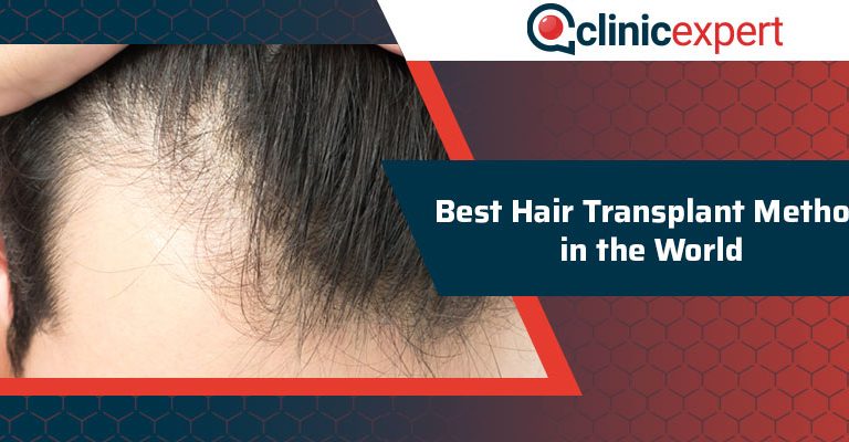 Best Hair Transplant Method In The World