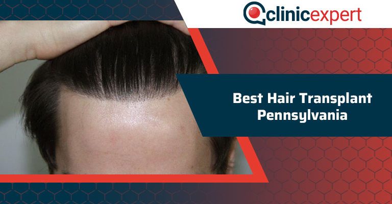 Best Hair Transplant Pennsylvania