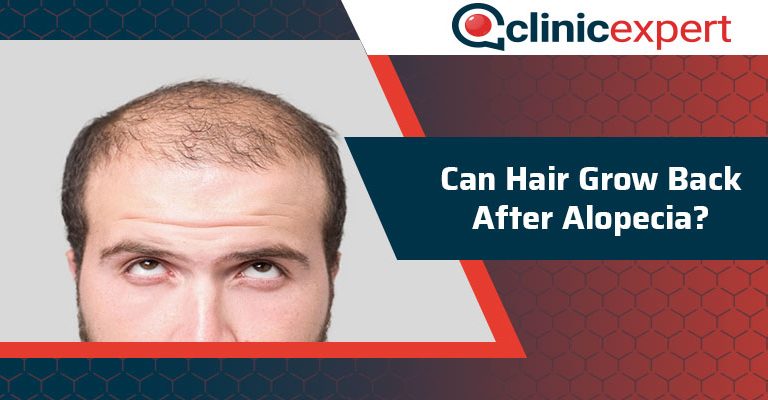 Can Hair Grow Back After Alopecia?