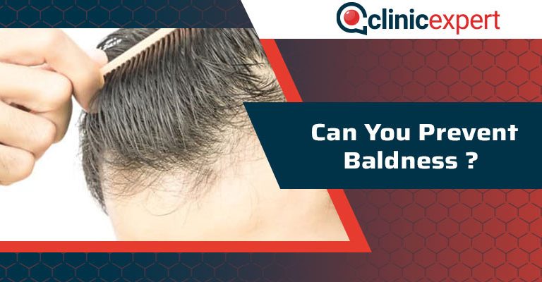 Can You Prevent Baldness?