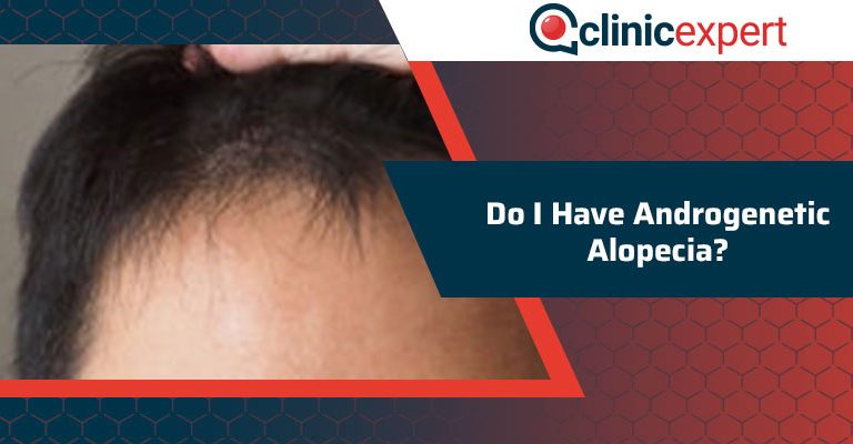 Do I have Androgenetic Alopecia?