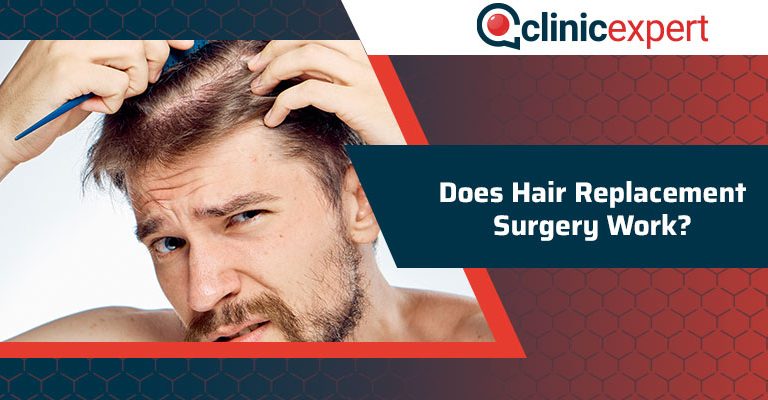 Does Hair Replacement Surgery Work?