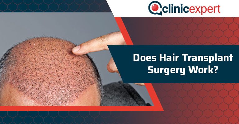 Does Hair Transplant Surgery Work?