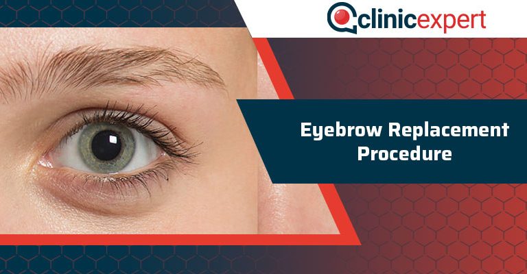 Eyebrow Replacement Procedure