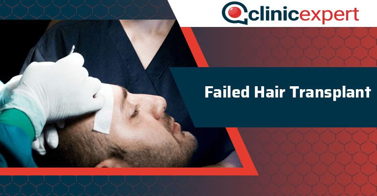 Failed Hair Transplant