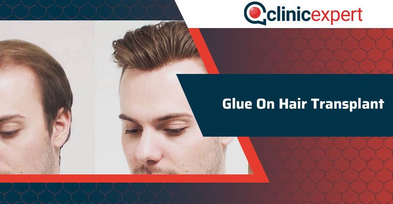 Glue On Hair Transplant