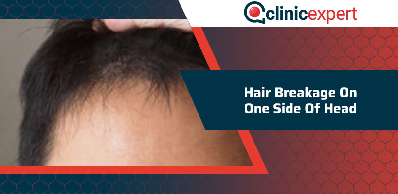 https://www.clinicexpert.com/eng/wp-content/uploads/2021/01/hair-breakage-on-one-side-of-head-cln.jpg