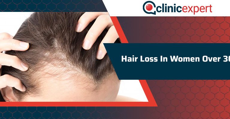 Hair loss In Women Over 30