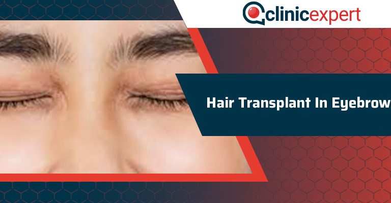 Hair Transplant In Eyebrow