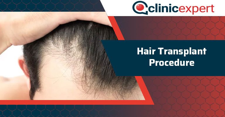 Hair Transplant Procedure