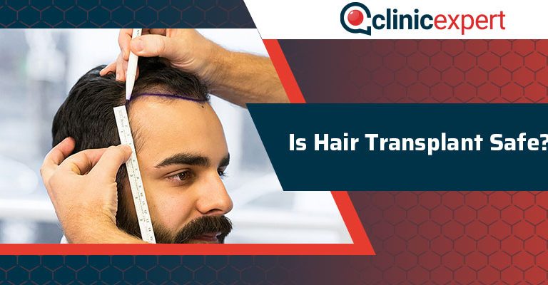 Is Hair Transplant Safe?