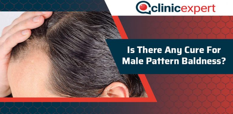 Is There Any Cure For Male Pattern Baldness? | ClinicExpert