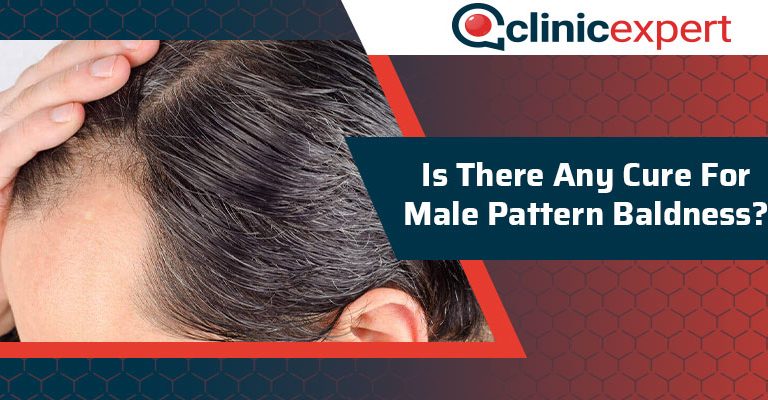 Is There Any Cure For Male Pattern Baldness?