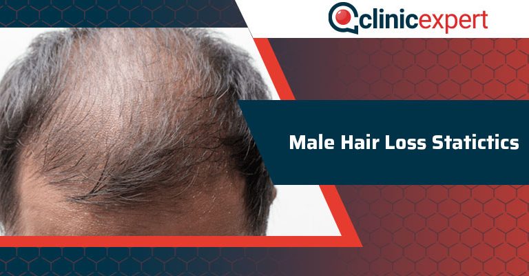 Male Hair Loss Statictics