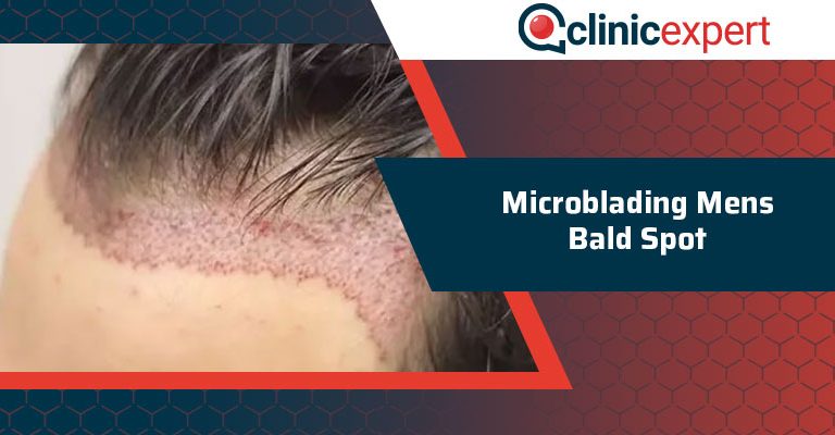 Microblading Mens Bald Spot