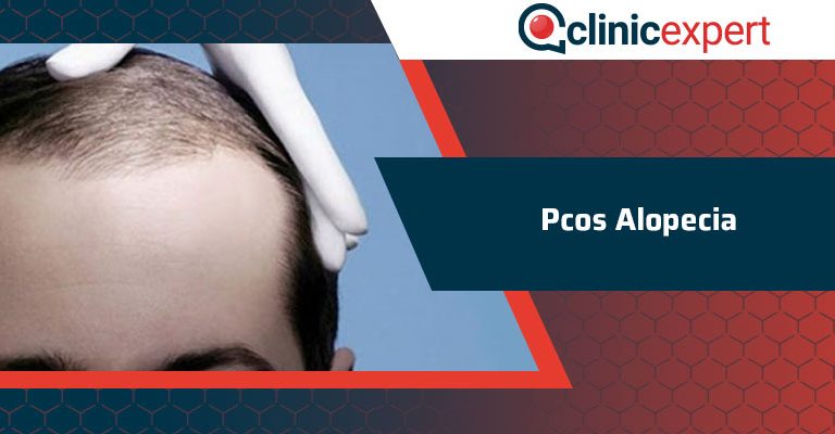 Pcos Alopecia 