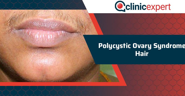 Polycystic Ovary Syndrome Hair