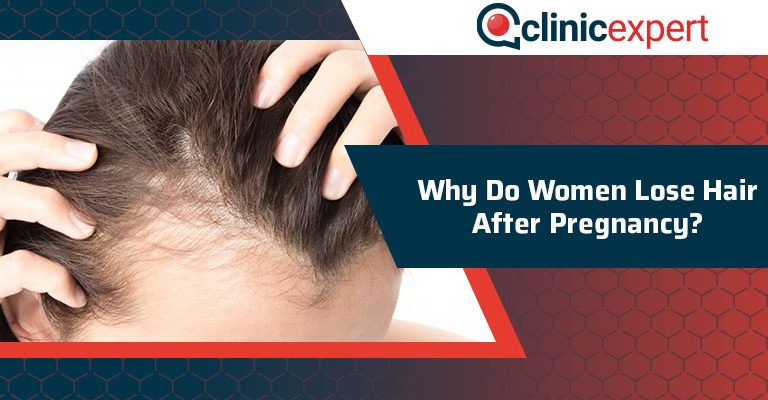 Why Do Women Lose Hair After Pregnancy?