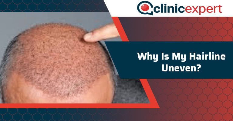 Why Is My Hairline Uneven?