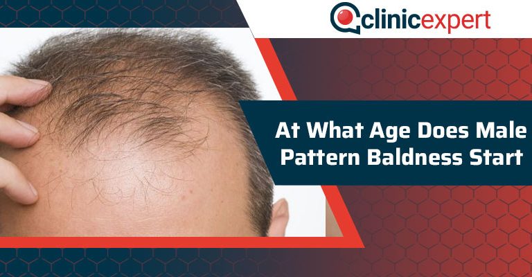 At What Age Does Male Pattern Baldness Start?