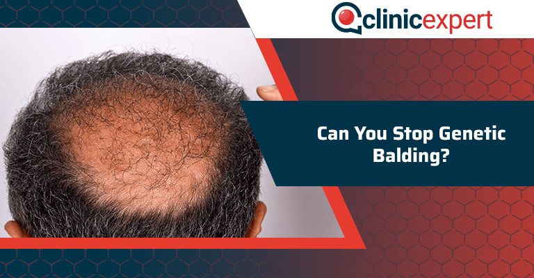 Can You Stop Genetic Balding?