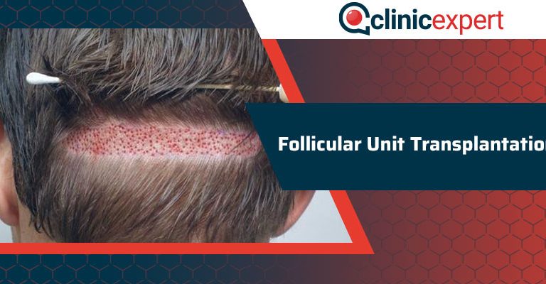 Follicular Unit Transplantation