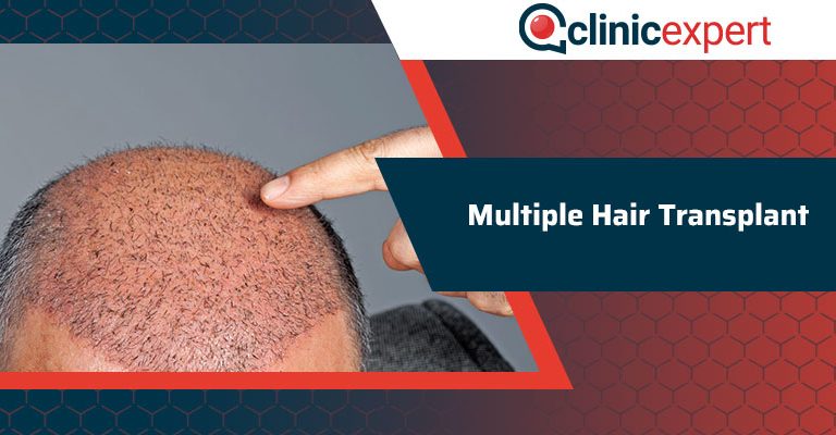 Multiple Hair Transplant 