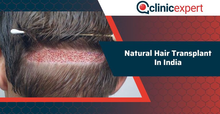 Natural Hair Transplant In India