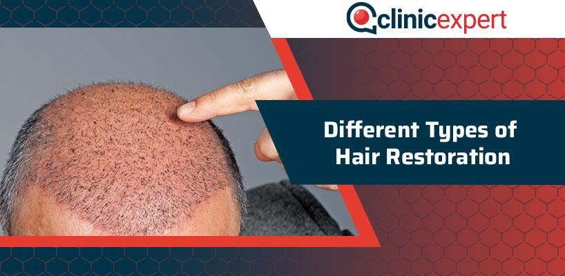 Different Types of Hair Restoration