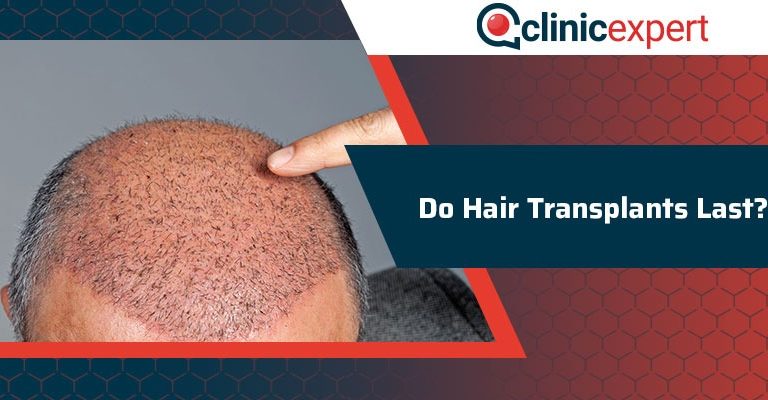 Do Hair Transplants Last?