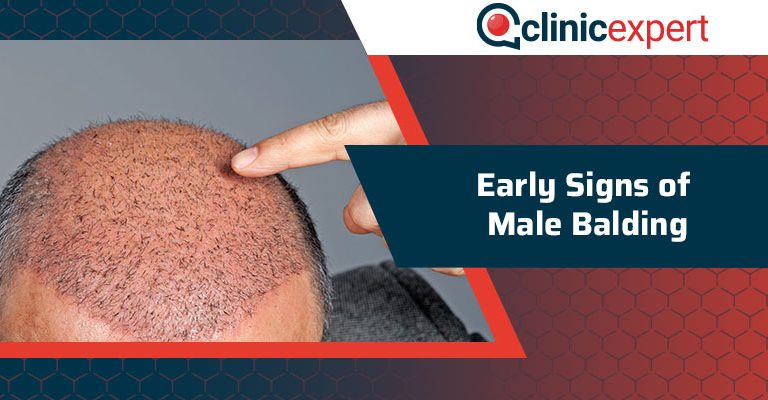 Early Signs of Male Balding