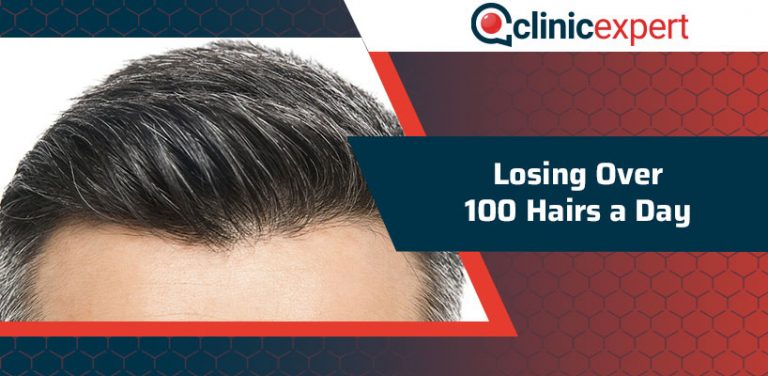 Losing Over 100 Hairs A Day | ClinicExpert