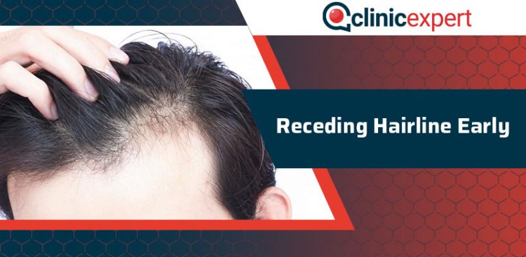 Receding Hairline Early | ClinicExpert