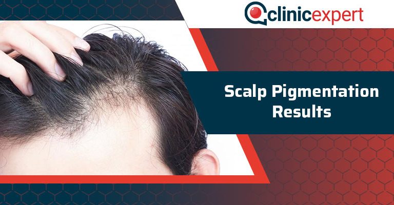 Scalp Pigmentation Results