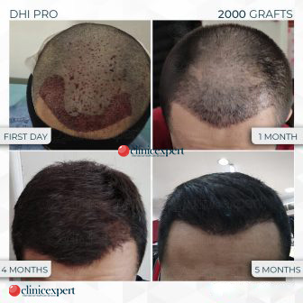 Five Months PostHair Transplant Recovery  Results Guide