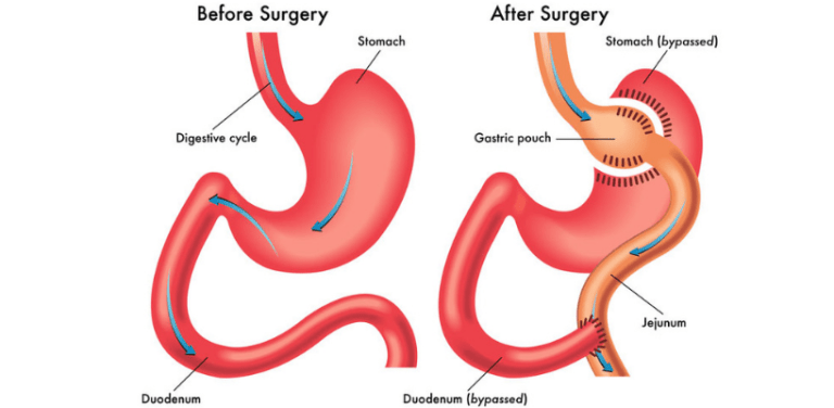 Gastric Bypass vs. Lap Band | ClinicExpert